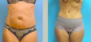 Fort Worth - Tummy Tuck after Pregnancy