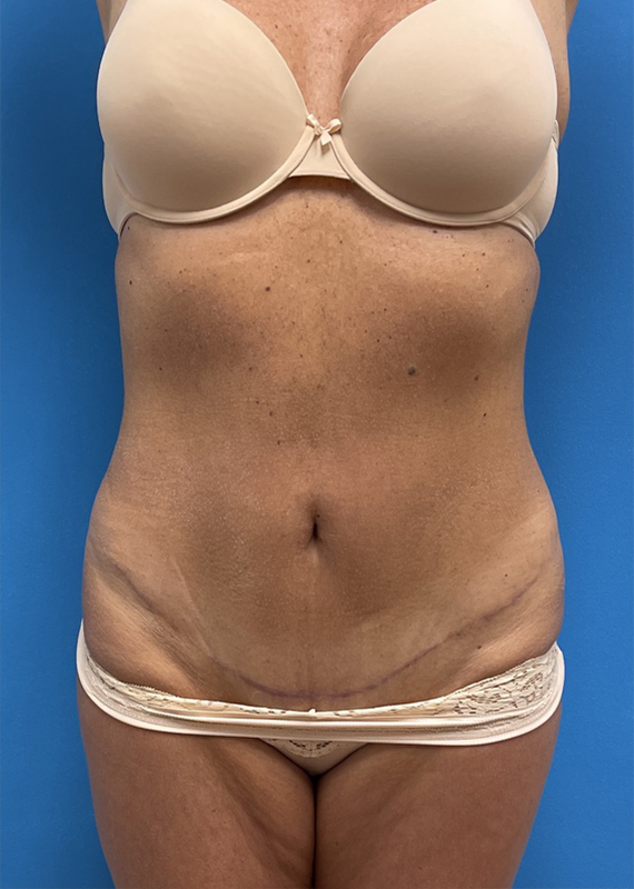 Mini Tummy Tuck Before & After Photos Fort Lauderdale, Coral Springs