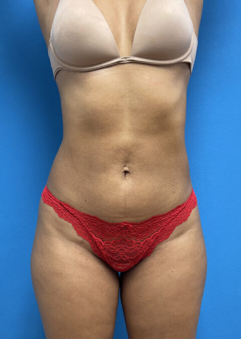 Liposuction With Renuvion Before And After Pictures Near Fort Lauderdale Fl David J Levens Md