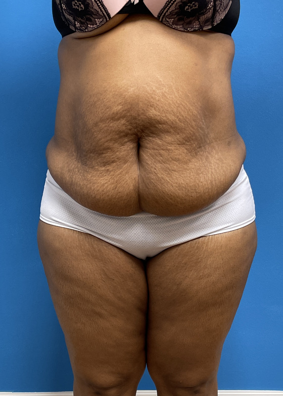 Tummy Tuck Before & After Pictures near Fort Lauderdale, FL