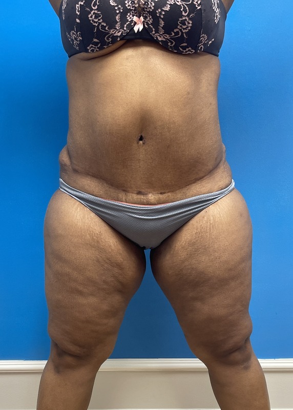 Liposuction with Renuvion Before & After Pictures near Fort Lauderdale, FL