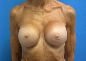 Breast Implant Revision/Replacement Before & After Pictures near Fort Lauderdale, FL