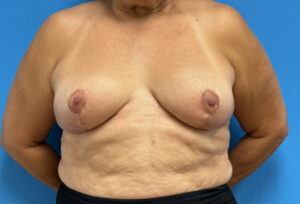 Breast Implant Removal Before & After Pictures near Fort Lauderdale, FL