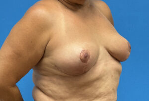 Breast Implant Removal Before & After Pictures near Fort Lauderdale, FL