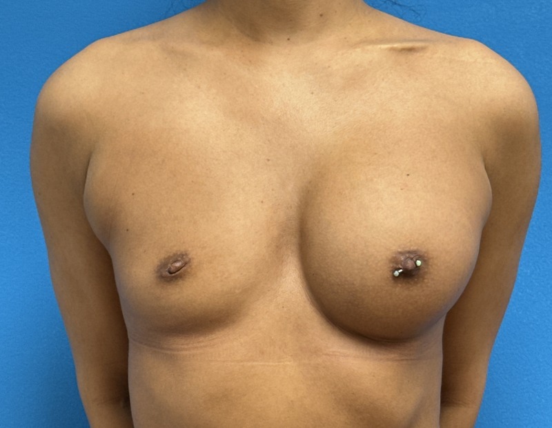 Breast Implant Revision/Replacement Before & After Pictures near Fort Lauderdale, FL